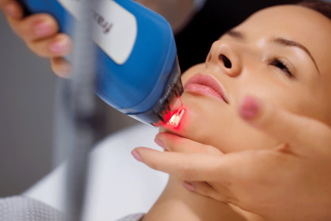 lasersko pomlađivanje kože lica
