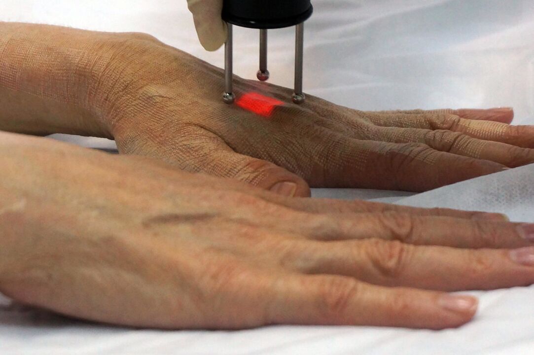 Lasersko pomlađivanje ruku neablativnom metodom