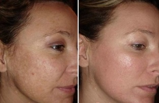 lasersko pomlađivanje kože lica prije i poslije fotografija